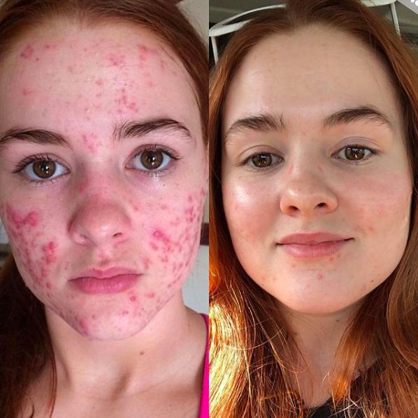 Anti acne cream